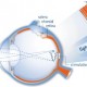 retinal implant