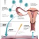 in vitro fertilization