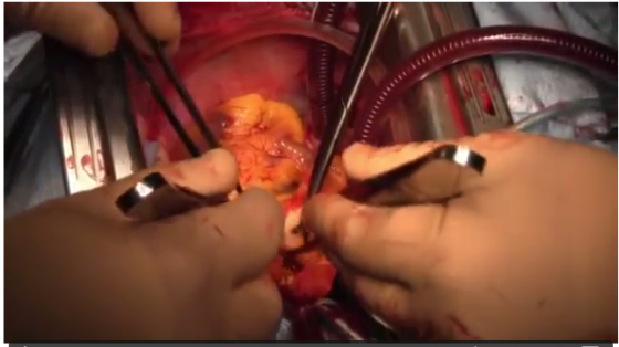 Full heart transplantation surgery step by step
