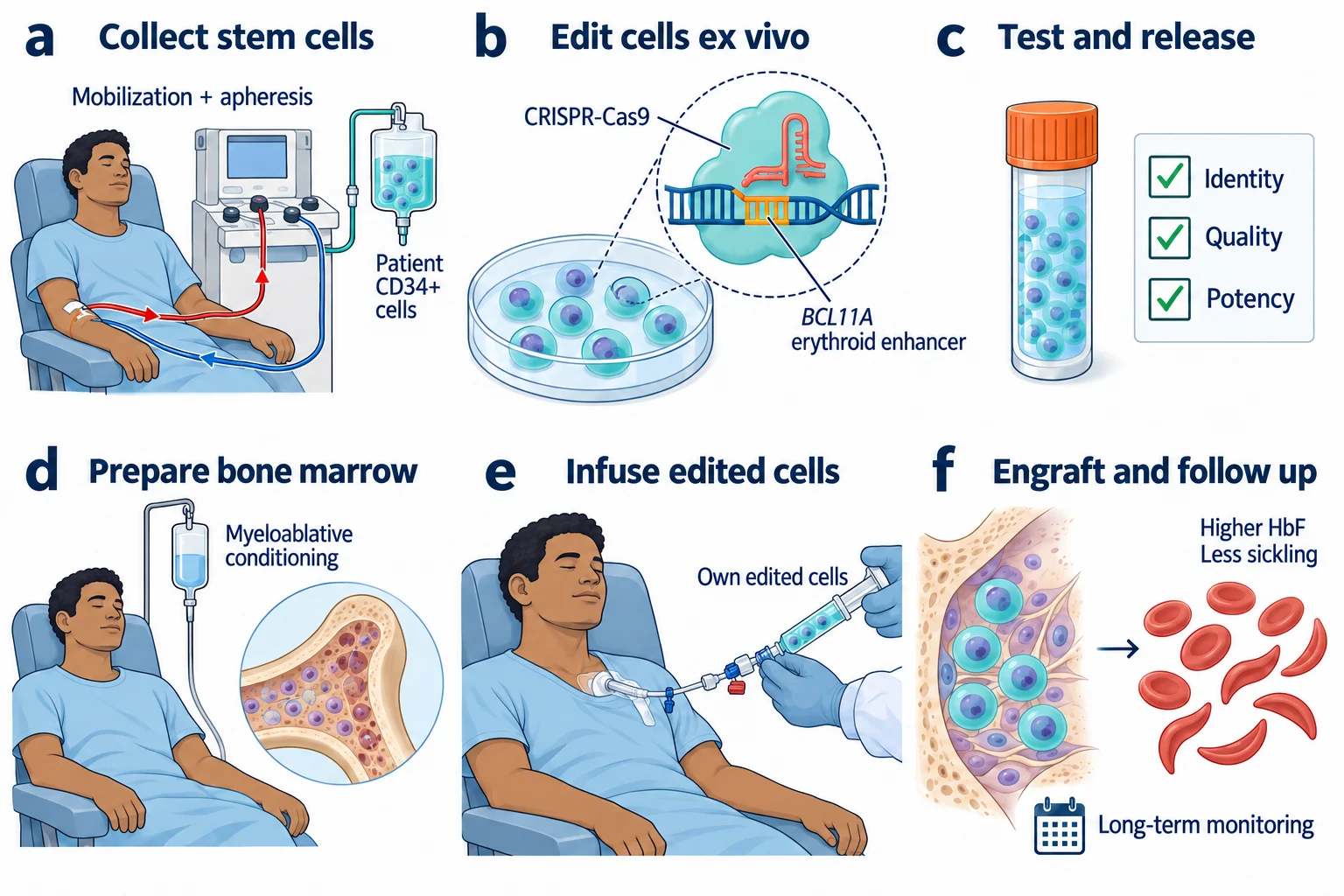 หกขั้นตอนการรักษา sickle cell disease ด้วย CASGEVY ตั้งแต่เก็บเซลล์ CD34+ ของผู้ป่วย ตัดต่อ BCL11A enhancer ตรวจผลิตภัณฑ์ เตรียมไขกระดูก ให้เซลล์กลับ และติดตามการฝังตัวกับการเพิ่ม HbF