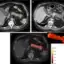 ภาพ CT ตับอ่อนที่ถูกอ่านว่าปกติ ภาพ CT 2.4 ปีต่อมาที่พบเนื้องอก และแผนที่ลักษณะเนื้อเยื่อจาก REDMOD